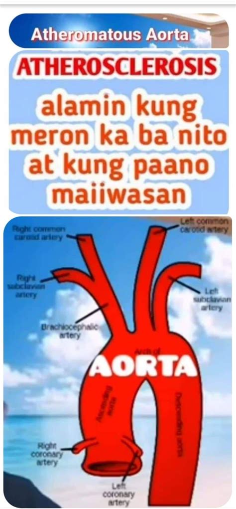 atheromatous aorta meaning tagalog